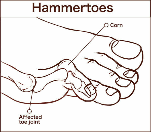 What Is Hammertoes?