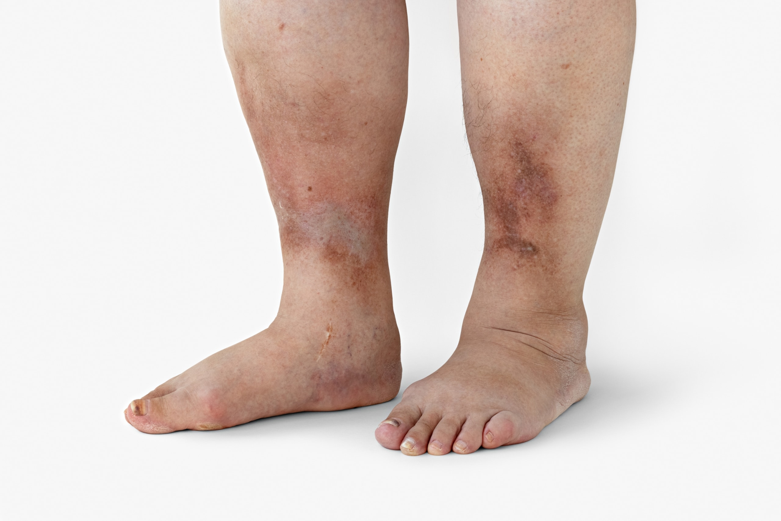 5-symptoms-of-diabetes-on-feet-and-ankles