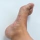 infectious-disease-legs-foot-fungus-allergic-rash