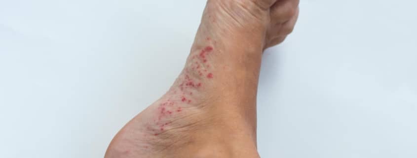 infectious-disease-legs-foot-fungus-allergic-rash