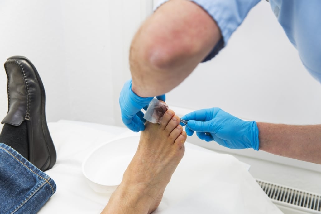 Treatment Options For Ingrown Toenails