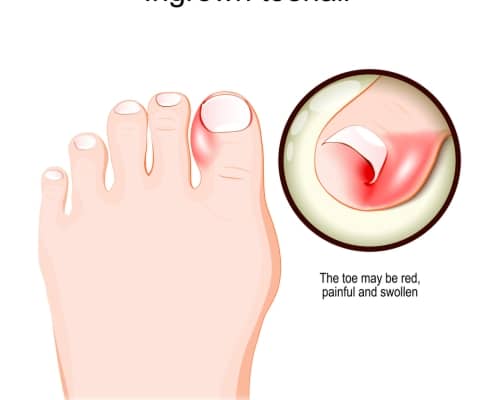 Ingrown toenail. Human foot.