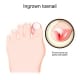 Ingrown toenail. Human foot.
