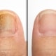 Before and after successful treatment for a fungal infection on toe